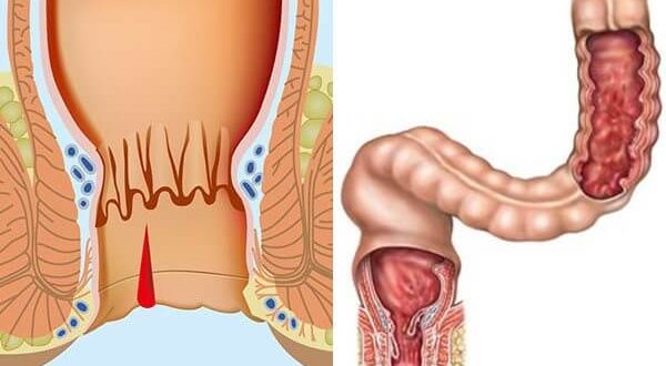 проктология