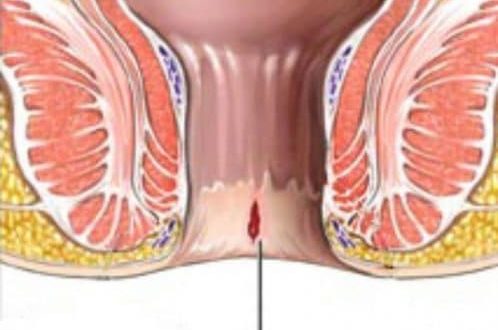 анальная трещина